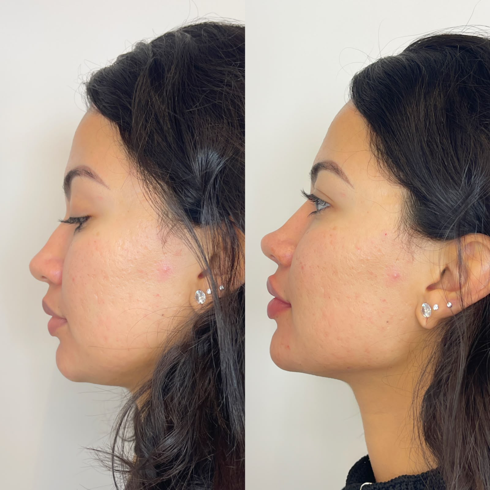 Comparação antes e depois do perfil de paciente feminina