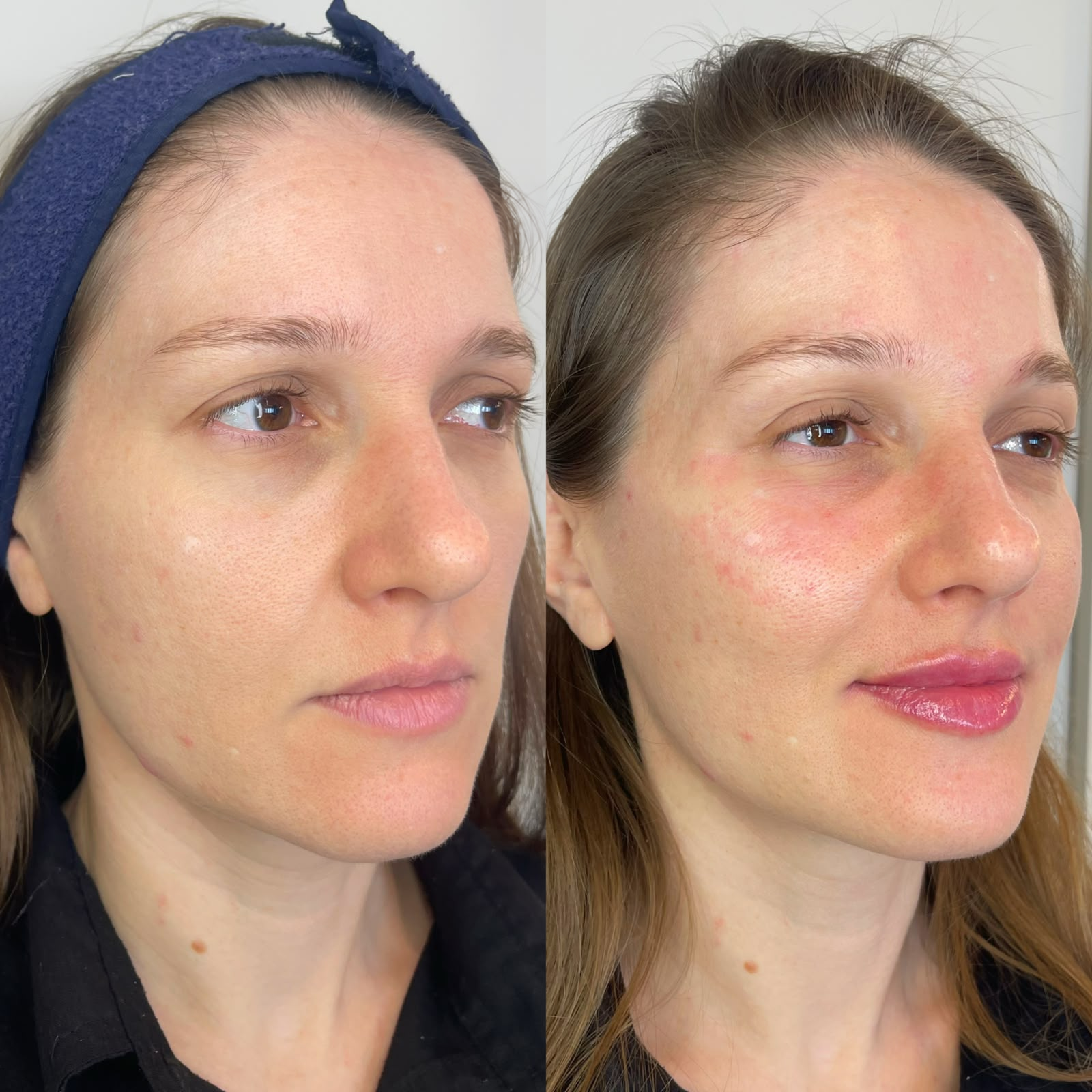 Comparação antes e depois do rosto feminino em vista de três quartos