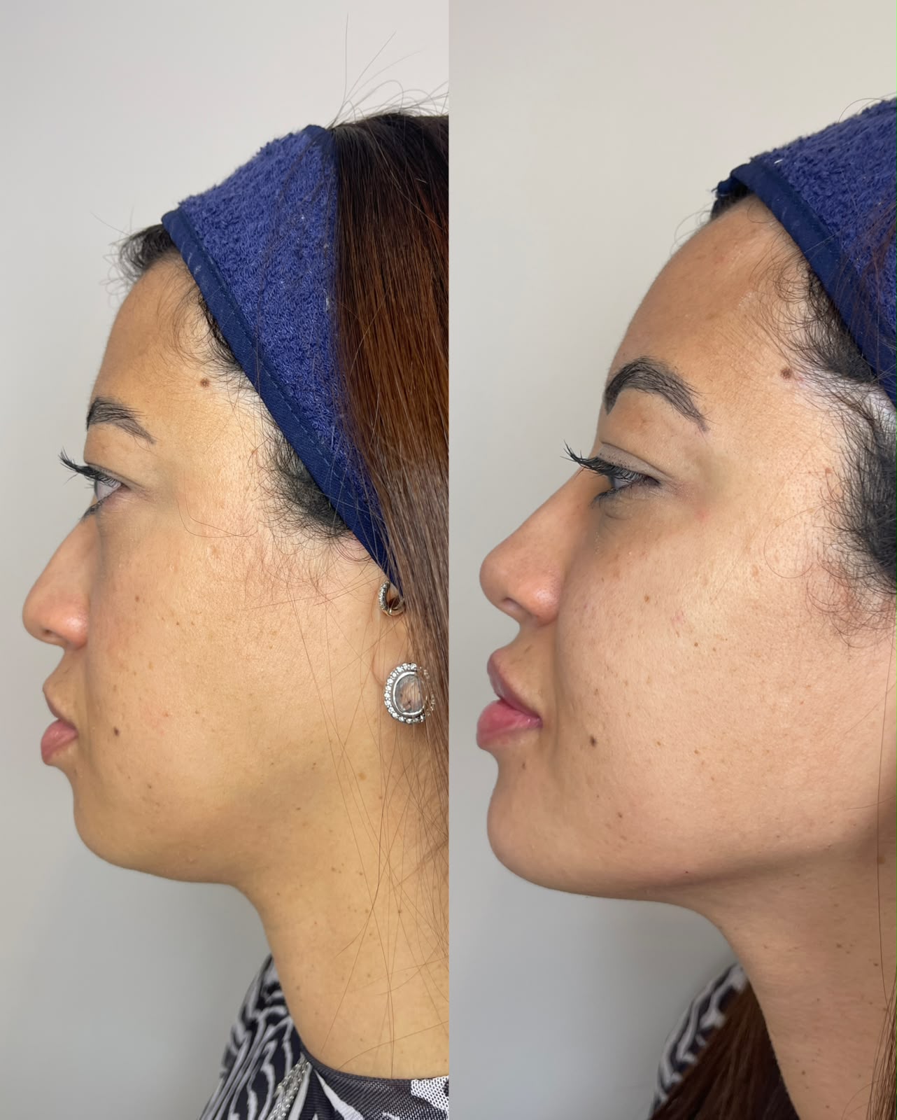 Comparação antes e depois do contorno nasal em perfil