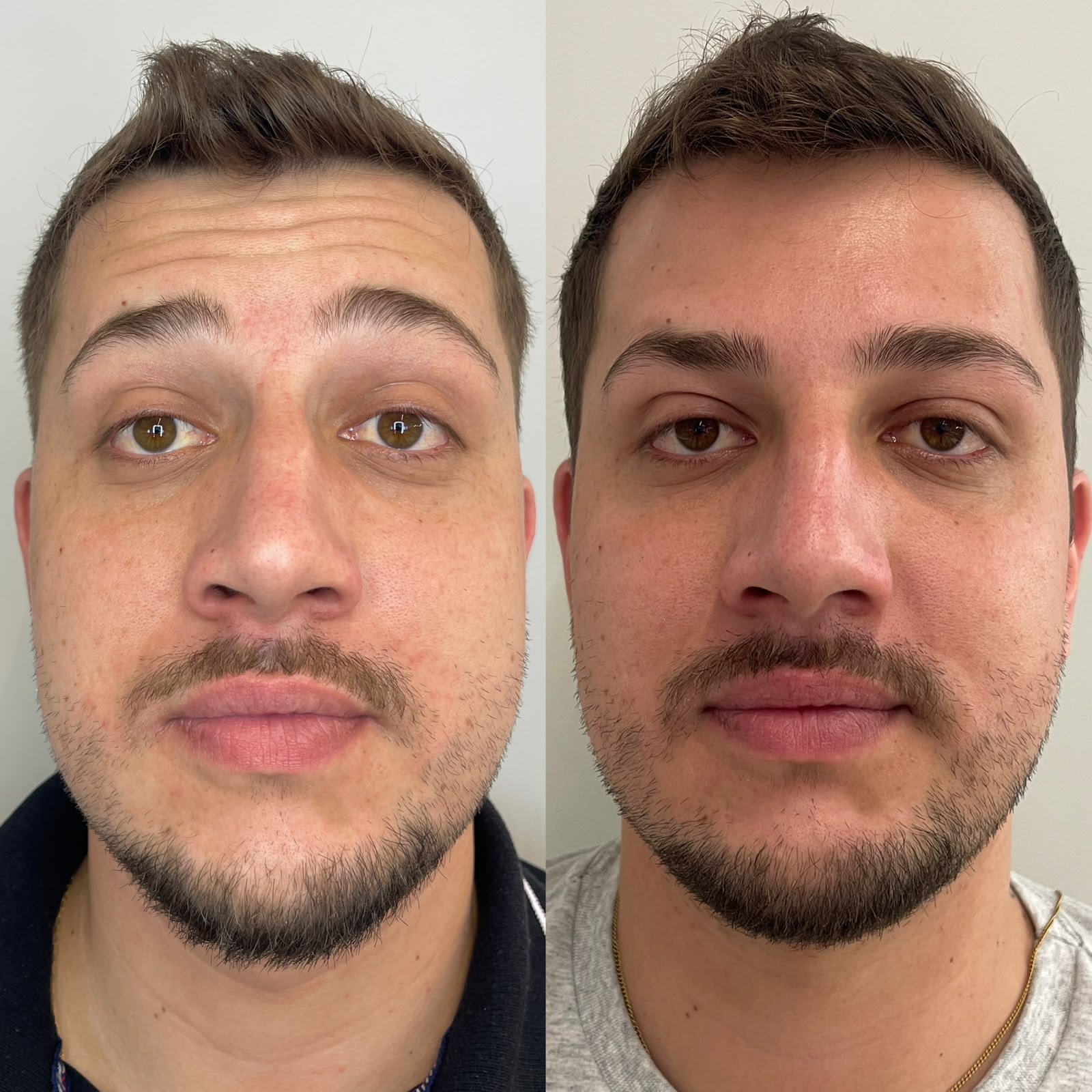 Comparação antes e depois de paciente masculino em vista frontal