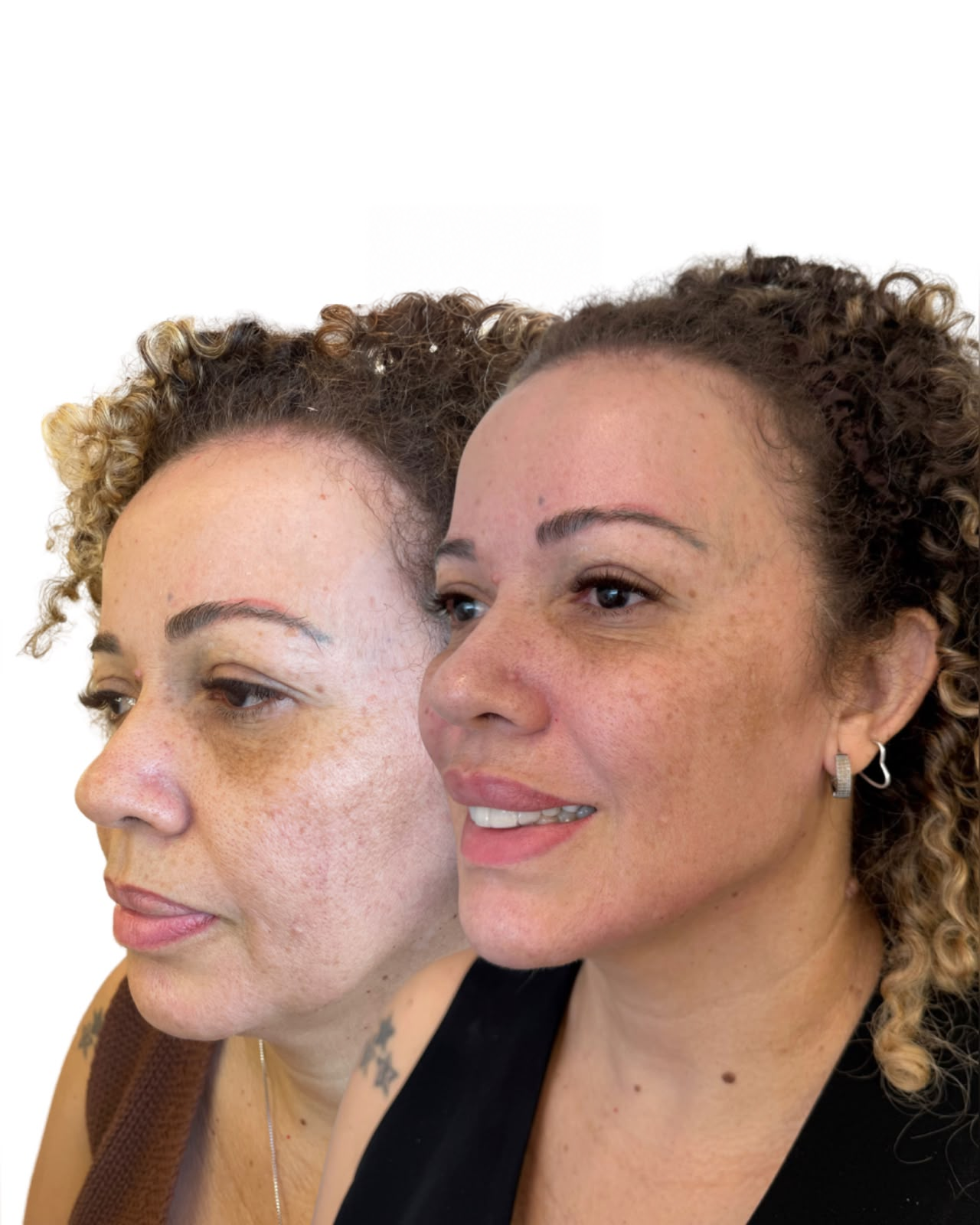Comparação antes e depois de paciente feminina em vista de três quartos