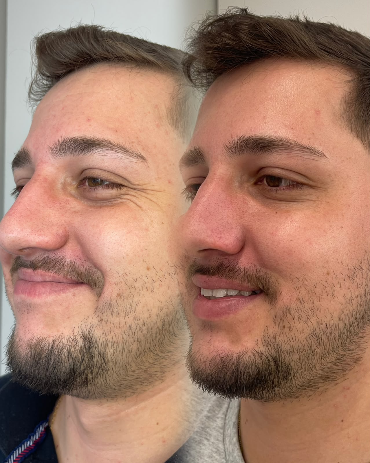 Comparação antes e depois do rosto masculino em vista de três quartos