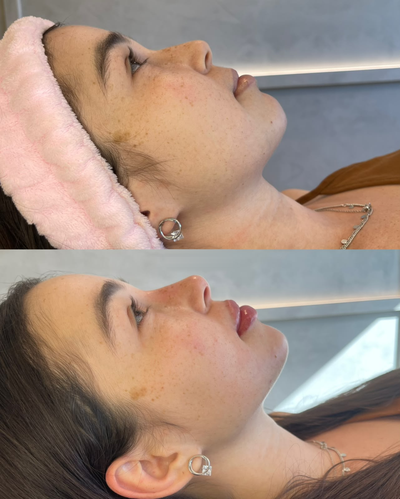 Comparação antes e depois do perfil feminino em posição reclinada