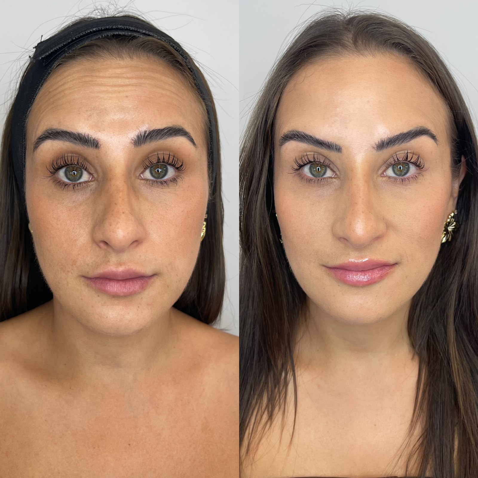 Comparação antes e depois de paciente feminina em vista frontal