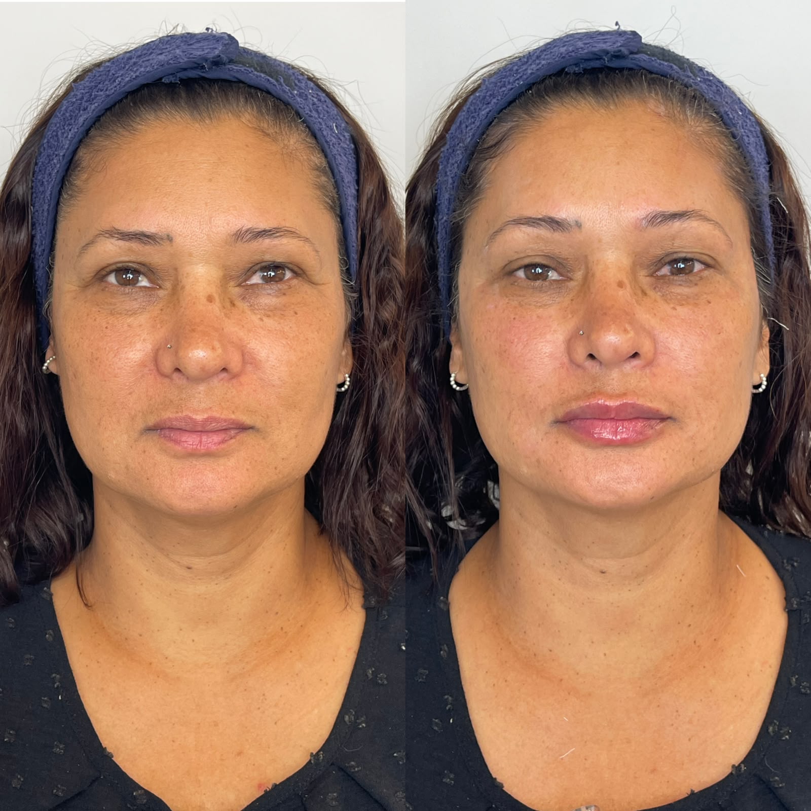 Comparação antes e depois de paciente feminina com faixa azul em vista frontal
