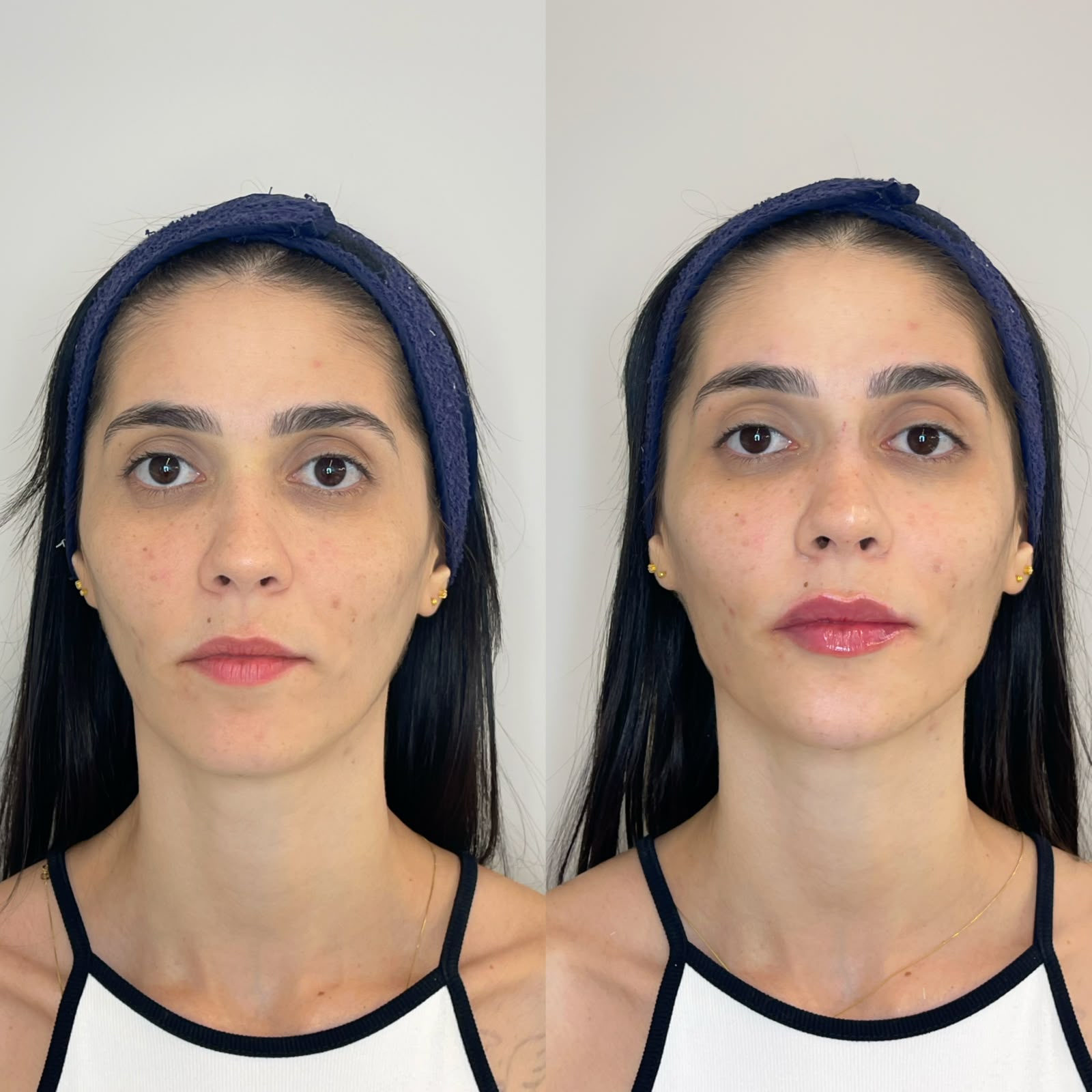 Comparação antes e depois de paciente feminina de cabelos escuros em vista frontal