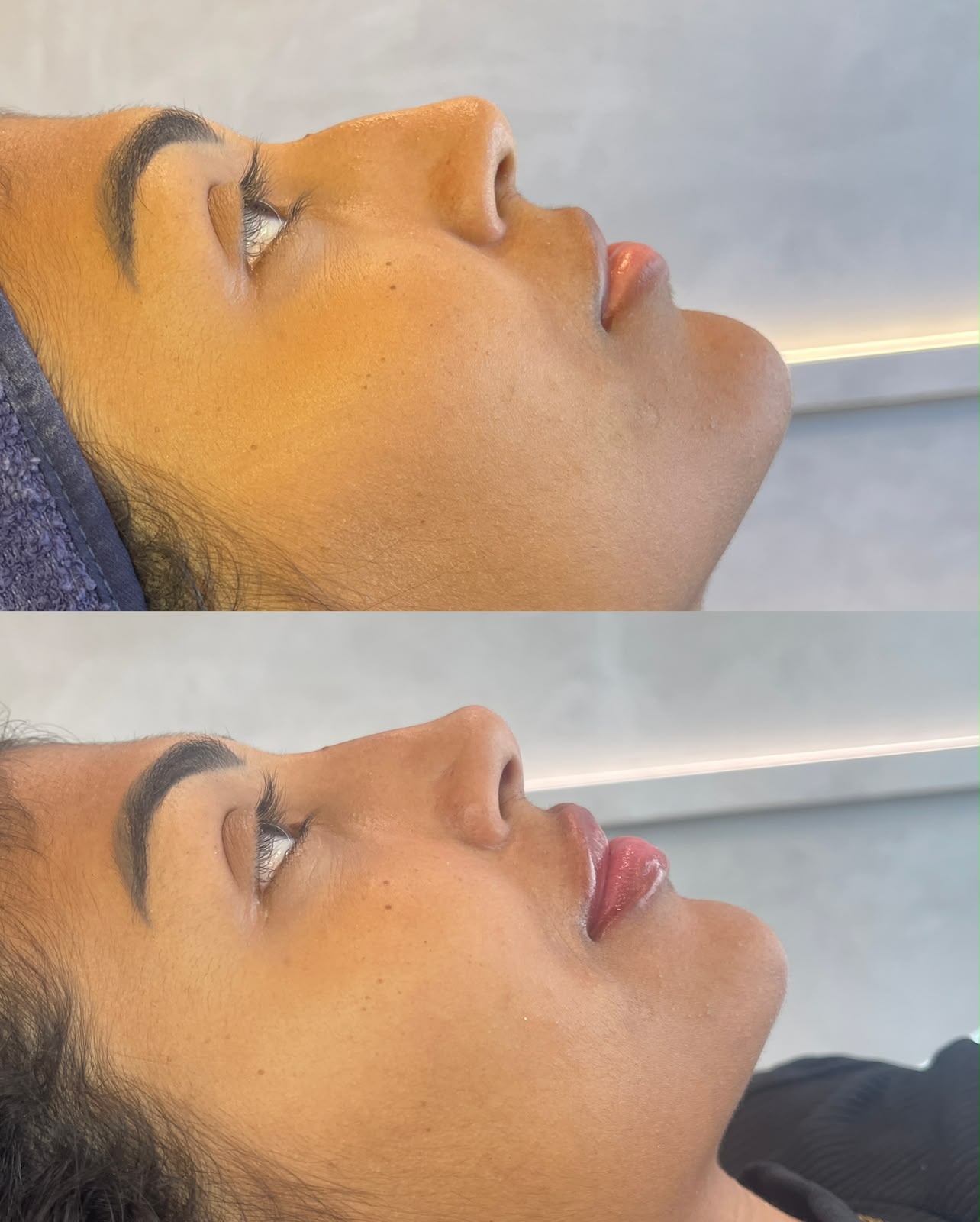 Comparação antes e depois do perfil nasal feminino em posição reclinada